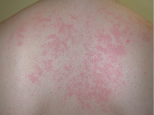 Patient with AOSD rash.